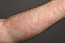 urticaria_on_arm_resized_detail.jpg